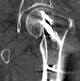 Subcapital NOF Nonunion CT